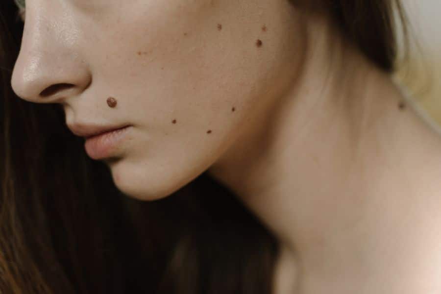 Tratamiento dermatológico para melasma